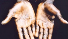 Monkeypox outbreak constitutes global health emergency: WHO 