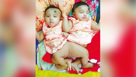 First conjoined twin separation surgery at BSMMU this month 