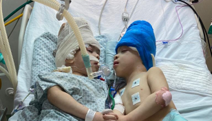 Conjoined twins separated with help of virtual reality in Brazil