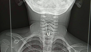 3-year-old girl swallows safety pin while eating noodles