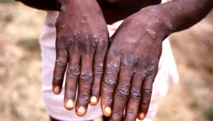 Saudi Arabia reports 1st monkeypox case