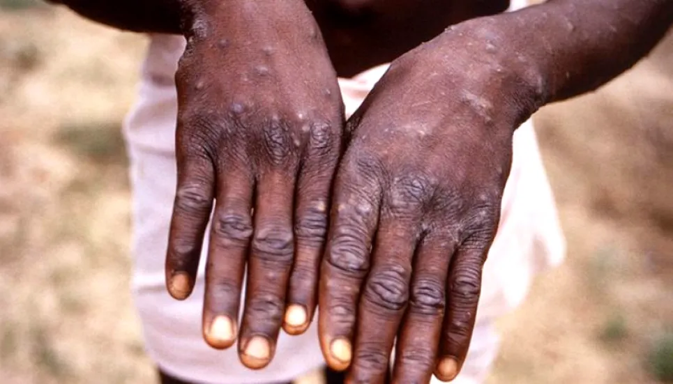 UK monkeypox symptoms different to prior outbreaks: Study