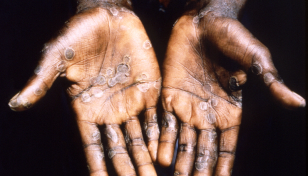 US ramps up monkeypox vaccination campaign