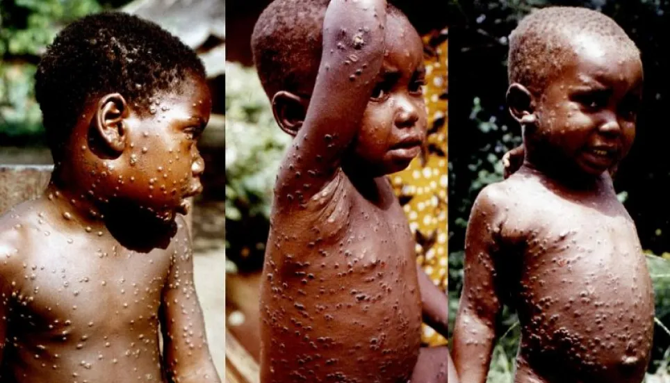 Why monkeypox cases are spreading in Europe, US