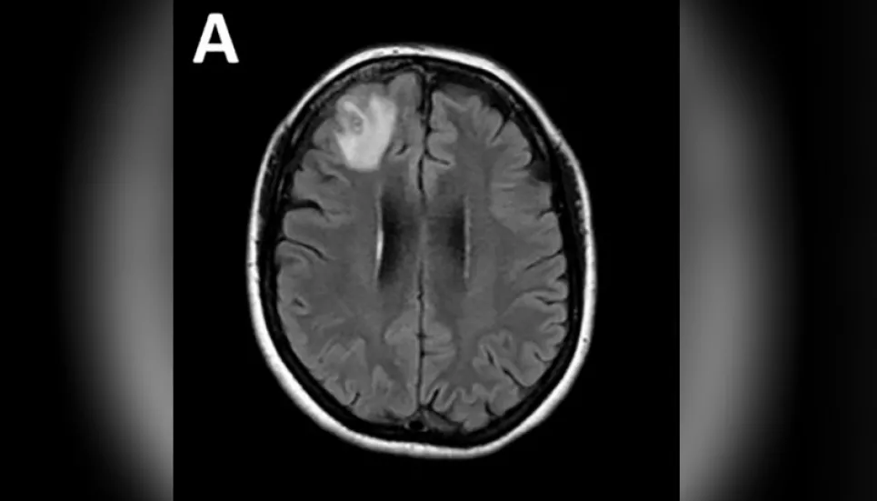 Live worm found in woman's brain in Australia